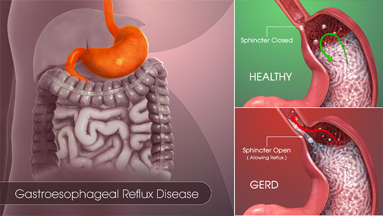 Gastroesophageal-Reflux-Disease(GERD)
